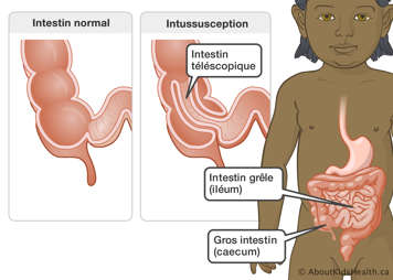 L’intestin grêle et le gros intestin dans un enfant et des gros plans sur un intestin normal et un intestin téléscopique