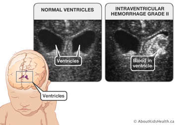 Normal head ultrasound and IVH grade II ultrasound with bleeding in ventricles