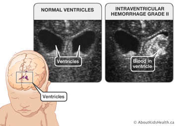 Head ultrasound showing normal ventricles and head ultrasound showing a grade II intraventricular hemorrhage