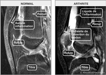 IRM d’une articulation du genou normale et IRM d’une articulation arthritique d’un genou