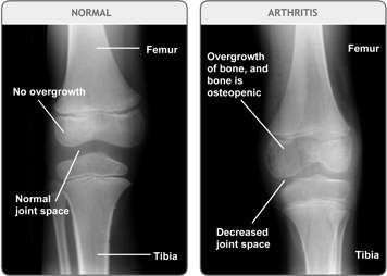 X-ray of normal knee joint and x-ray of arthritic knee joint with overgrowth of bone and decreased joint space