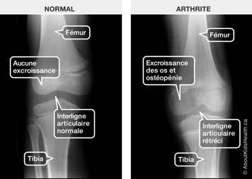 Radiographie d’une articulation du genou normale et radiographie d’une articulation du genou arthritique avec ostéopénie