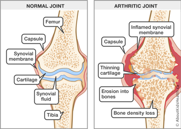 Normal knee joint and arthritic knee joint