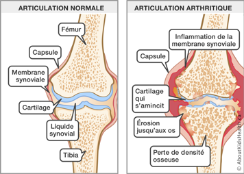 Articulation du genou normale et articulation du genou arthritique