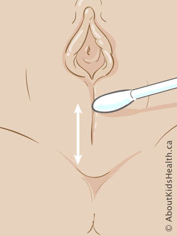Cotton swab over fused labia minora, with upward and downward arrows indicating movement of cotton swab