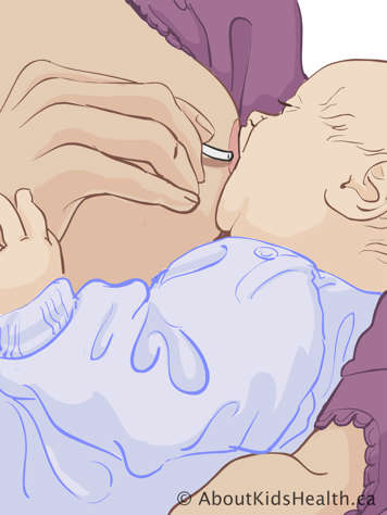 Glissant le tube d’alimentation au long du sein et dans la bouche du bébé lorsque le bébé est bien placé au sein