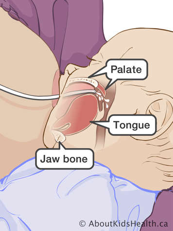 Correct position of lactation aid tube in baby’s mouth