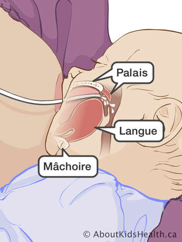 Position correcte du tube d’alimentation dans la bouche du bébé