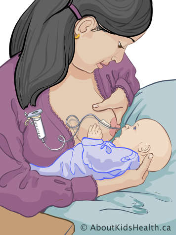 Mère allaitant son bébé à l’aide d’un système de nutrition supplémentaire avec une seringue
