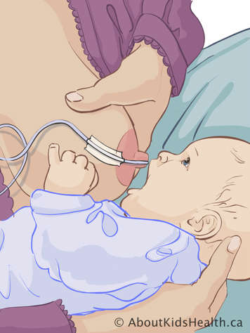 Rapprochant la bouche du bébé au sein avec le tube d’alimentation attaché