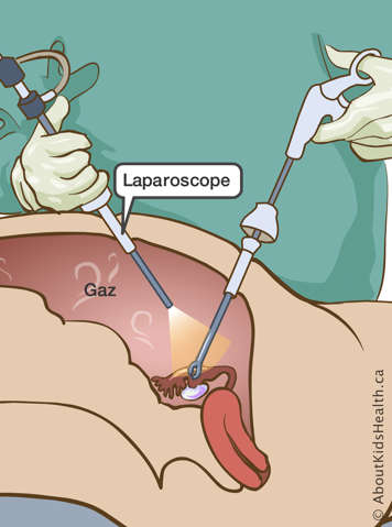 Un laparoscope et du gaz dans l’abdomen