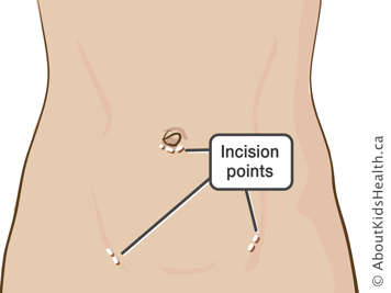 Incision points under belly button and on lower abdomen