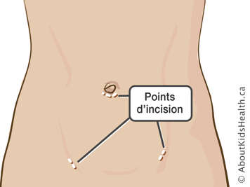 Points d’incision sous le nombril et sur le bas de l’abdomen