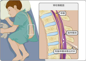 椎骨、脊髓、脑脊髓液（CSF）以及细针插入抽取CSF示意图