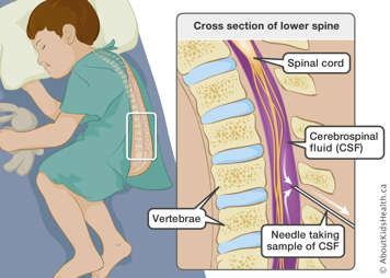 The vertebrae, spinal cord, cerebrospinal fluid (CSF) and needle taking sample of CSF, with arrows showing fluid movement