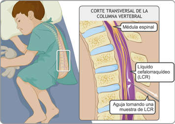 Vértebras, médula espinal y líquido cefalorraquídeo (LCR) con aguja insertada para tomar una muestra del líquido
