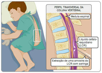 As vértebras, medula espinal e líquido cefalorraquidiano (LCR), com agulha retirando amostra do LCR