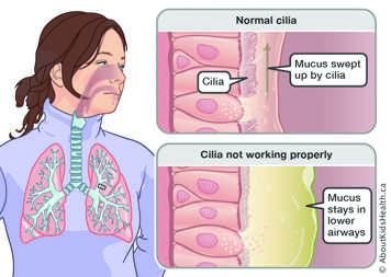 Normal cilia sweeping up mucus compared to when the cilia do not work properly and mucus stays in the lower airways