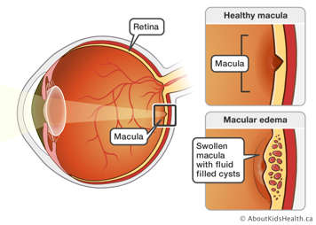 Inside view of the eyeball showing a side by side comparison of a healthy macula versus a macula showing macular edema
