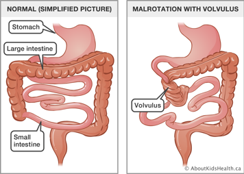 Simplified picture of normal stomach and small and large intestines, and an illustration of malrotation with volvulus