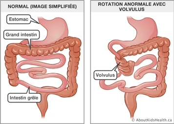 Image simplifiée d’un estomac, grand instestin et intestin grêle normaux, et illustration de rotation anormale avec volvulus