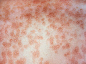 Close-up of measles rash