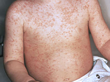 Torso of child with measles rash