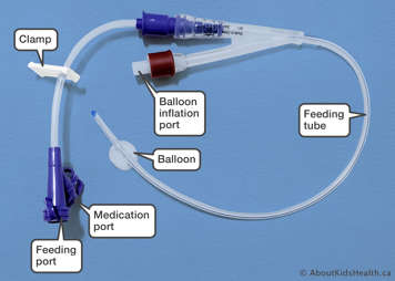 Medline catheter showing feeding tube, feeding port, medication port, balloon port and balloon