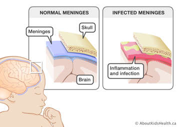 Close-ups of normal meninges between the skull and brain, and infected meninges with inflammation