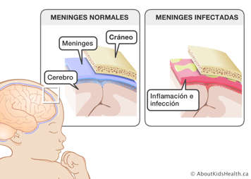 Primer plano de meninges normales entre el cráneo y el cerebro, y de meninges infectadas e inflamadas