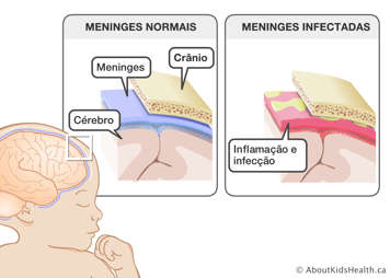 Ilustração ampliada de meninges normais entre o crânio e o cérebro e meninges infetadas apresentando inflamação