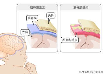 近距离示意图：位于头骨和大脑之间的正常脑膜，以及发炎的脑膜