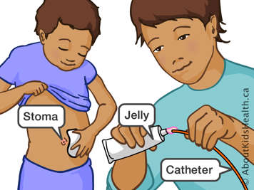 Child cleaning stoma and caregiver applying jelly to end of catheter