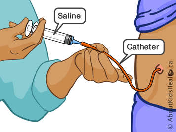 Injecting saline solution into catheter with a syringe