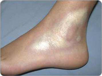 Plaque morphea on ankle