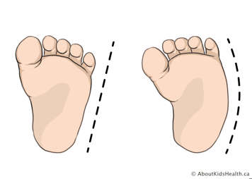 Normal baby foot on left compared to curved baby foot with metatarsus adductus on right