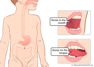 Sores in the mouth and on the side of the tongue