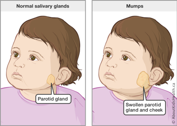 Toddler with normal parotid gland, located along the jaw near base of ear, and toddler with swollen parotid gland and cheek