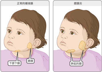腮腺位于两侧耳根处，靠近下颌线。图中分别为腮腺正常的幼童，以及腮腺及面颊肿胀的幼童