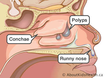 Illustration of polyps, conchae and runny nose