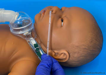 Catheter removed from packaging being used to measure the suctioning distance between the child's nostril and earlobe