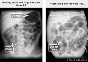 X-ray of healthy small and large intestines and x-ray of intestine affected by necrotizing enterocolitis