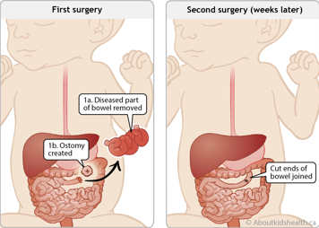 Removing diseased part of bowel and creating ostomy in first surgery and joining cut ends of bowel in second surgery