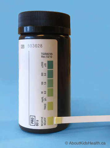 A dipstick bottle with a dipstick showing negative for protein