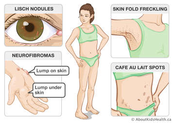 Lisch nodules on iris, lumps on and under the skin of hand, skin fold freckling on armpit, and café au lait spots on abdomen