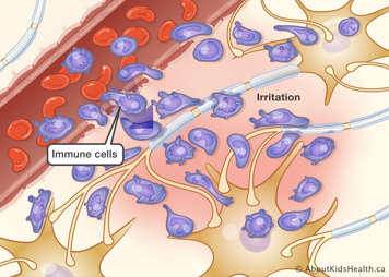 Inside the CNS showing a leaky blood-brain barrier and immune cells in the neuronal space damaging the neurons