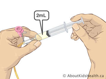 Two millilitres of liquid in a syringe attached to an NG tube