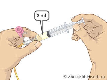 Deux millilitres de liquide dans une seringue attachée à une sonde nasogastrique
