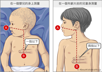 嬰兒及稍年長兒童的鼻胃管測量示意圖，以及二者胸骨底部和肚臍位置3: 在帶有兩個端口和可拆卸導線的鼻胃管上做標記