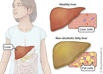 Location of the liver in the body shown with a side by side comparison of a healthy liver and liver cells versus non-alcoholic fatty liver and fatty cells